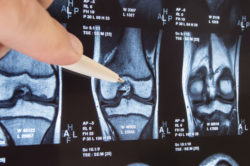 Zimmer Persona knee replacement knee implant knee joint MRI
