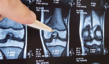 Zimmer Persona knee replacement knee implant knee joint MRI