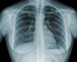 Detail of an x-ray of lungs on black background