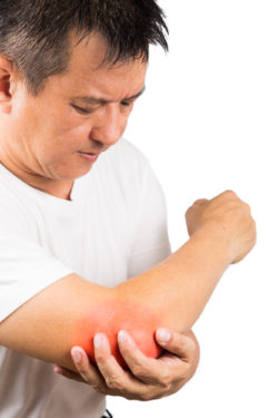 Uloric gout arthritis elbow