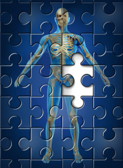 Human skeleton disease and osteoporosis of the hip bone concept with a puzzle texture and a missing piece as a medical and health care symbol of orthopedic and aging deterioration illness.