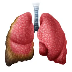 Mesothelioma cancer disease