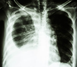 lung cancer