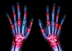 film x-ray both human's hands and arthritis at multiple joint (Gout,Rheumatoid)