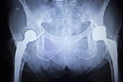 X-ray scan image of hip joints with orthopedic hip joint replacement implant head and screws in human skeleton in blue gray tones. Scanned in orthopedics traumatology surgery hospital clinic.