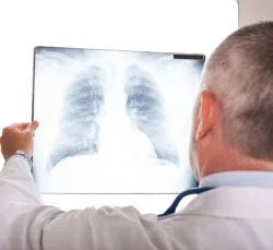 IVC filter vena cava filter doctor chest X-ray