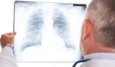 IVC filter vena cava filter doctor chest X-ray