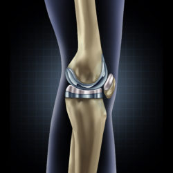 Knee replacement implant, Arthrex iBalance, TKA