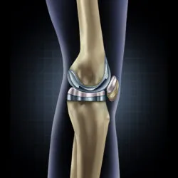 Knee replacement implant, Arthrex iBalance, TKA