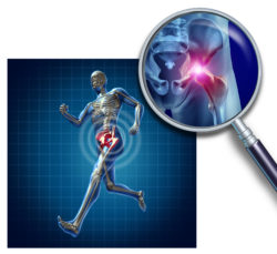 Sports Hip injury with a running athlete showing the anatomical skeleton with a red highlight on the hips magnified with a magnifying glass as a symbol of body joint pain.