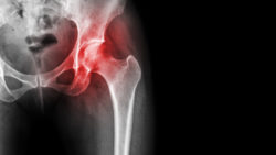 Arthritis at hip joint . inflamed of hip joint, Avascular necrosis.