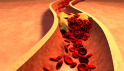 Tasigna, Clogged Artery with platelets and cholesterol plaque