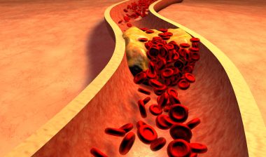 Tasigna, Clogged Artery with platelets and cholesterol plaque