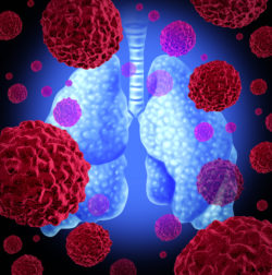 Human lung cancer organ as a medical symbol of a malignant tumor red cancer cell disease as a cancerous growth spreading through the respiratory system caused b