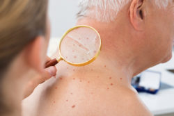 Viagra melanoma