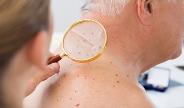 Viagra melanoma