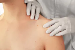 Dermatologist examining patient in clinic, closeup