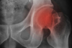 Close up Thigh bone x-ray