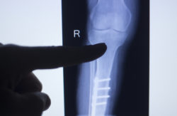 Knee joint xray test scan results of patient with arthritis and joints pain in knees with implant.