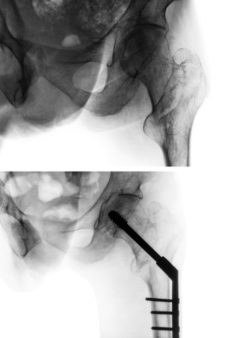 Intertrochanteric fracture femur ( thigh bone ). X-ray of hip and comparison between before surgery (upper image) and after surgery (lower image). Patient was operated and insert intramedullary nail .