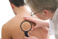 Dermatologist examines a mole of male patient, melanoma