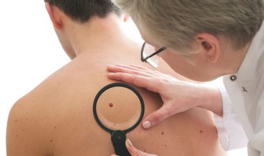 Dermatologist examines a mole of male patient, melanoma