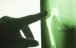 Hip joint replacement impant x-ray test scan results of old aged person with arthritis and joints pain.