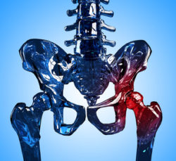 Skeleton hip segment made in 3D with pain areas. Isolated on blue background.