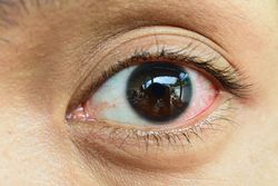 Close Up of irritated red blood eye.