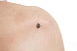 keratinizing squamous cell carcinoma of the skin on the back of an elderly man