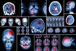 Zinbryta encephalitis brain inflammation MRI CT scan