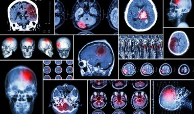Serious Zinbrya side effects may injure patients.