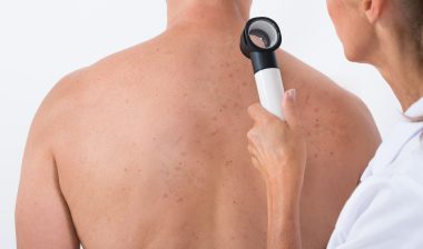 Viagra melanoma skin cancer doctor examining man