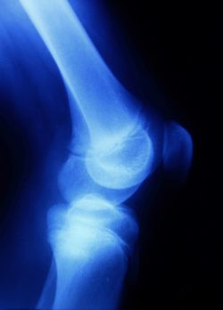Zimmer Persona knee implant knee replacement knee X-ray