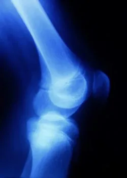 Zimmer Persona knee implant knee replacement knee X-ray