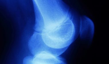 Zimmer Persona knee implant knee replacement knee X-ray