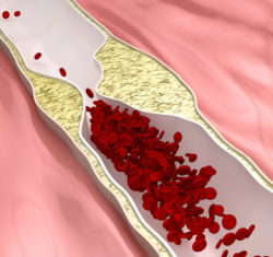 Atherosclerosis leads to Tasigna Lawsuit