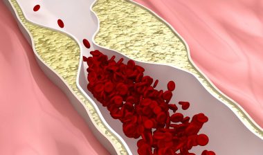 Atherosclerosis leads to Tasigna Lawsuit
