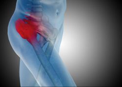 DePuy hip implant failure can lead to revision surgery
