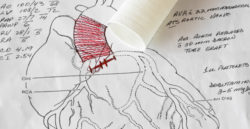 A Cardiac Surgeon's Open Heart Surgery Diagram for an Aorta and Aortic Valve Replacement