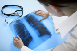 Doctor diagnosing patient xray as asbestos related pleural disease