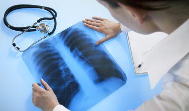 Doctor diagnosing patient xray as asbestos related pleural disease