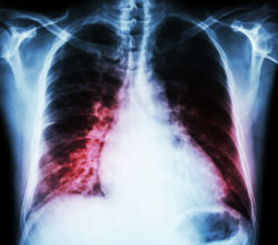 What Patients Should Know About the Onglyza FDA Warning