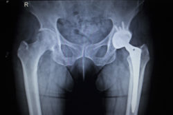 Viberzi-no-gallbladder