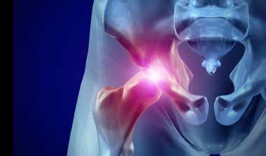 v40-femoral-head-failure
