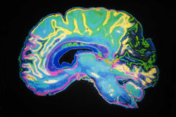 Colored MRI scan of brain, illustrating Zinbryta encephalitis cases