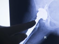 Xray of New Pinnacle Hip Implant Failure