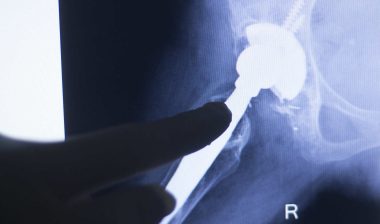 Xray of New Pinnacle Hip Implant Failure