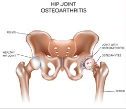 New DePuy ASR Hip Lawsuit Filed Over Defects