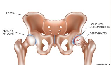 New DePuy ASR Hip Lawsuit Filed Over Defects